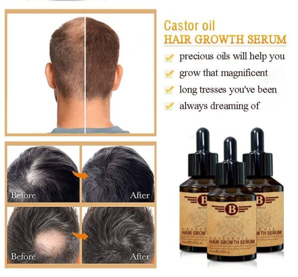 Treatment for Bald Hair Serum Herbal Anti Hair Loss Boosting Hair Growth Oil